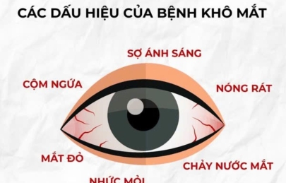 Khô Mắt Mùa Hè – Nguyên Nhân, Dấu Hiệu Và Cách Xử Lý Đúng Cách